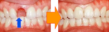 症例1：前歯を失ってしまった場合